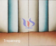 drilling technology-trepanning
